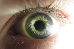 heterochromie